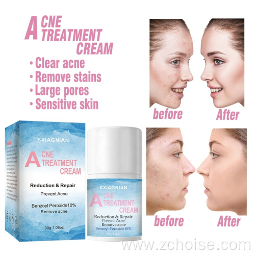 best pimple acne cream for face